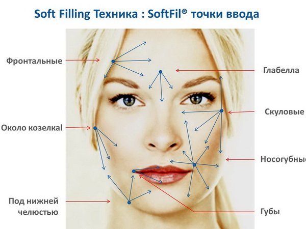 Місця та напрямку введення філерів при контурній пластиці обличчя