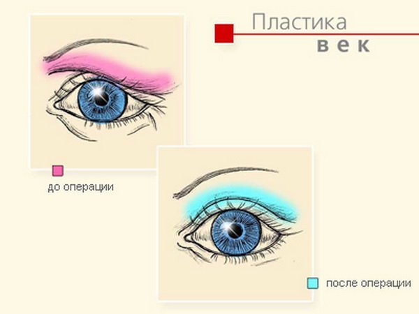 Пластика століття до і після