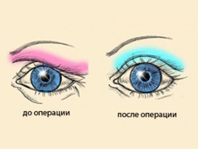 Після блефаропластики азіатських століття
