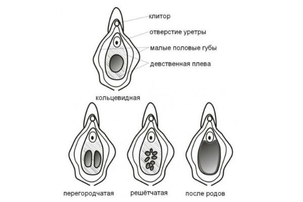 Дефлорація хірургічним шляхом