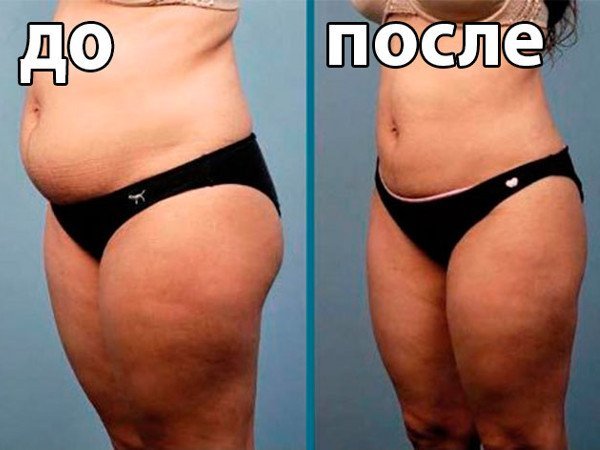 Операція ліпосакція: результати