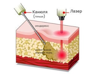 Лазер для безопераційної ліпосакції