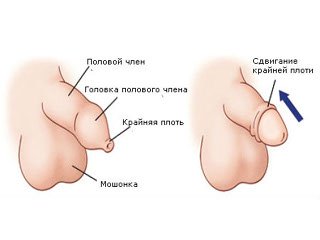 Пластика крайньої плоті при фімозі