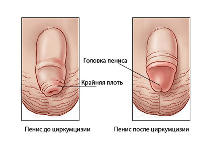 обрізання члена