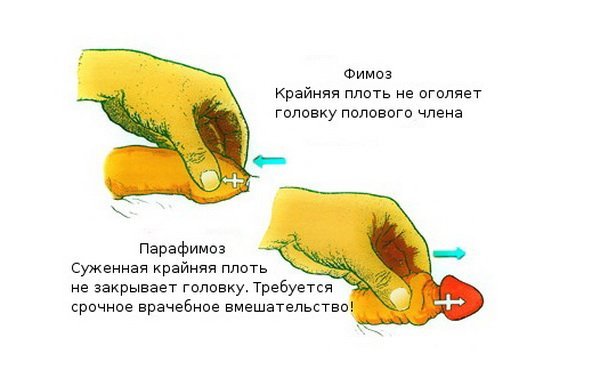 Медичні показання до операції обрізання крайньої плоті