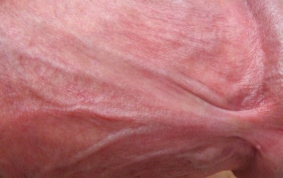 Коротка вуздечка крайньої плоті