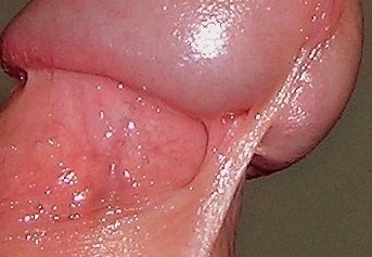 Пластика вуздечки крайньої плоті