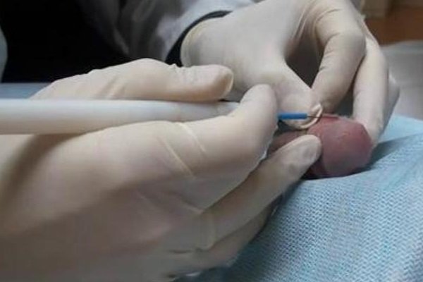 Операція по подовженню вуздечки
