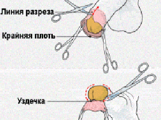 пластика вуздечки