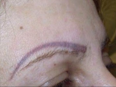 Видалення брів лазером