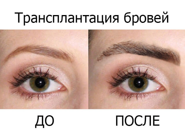 До і після трансплантації брів