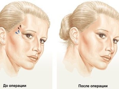 Скронева підтяжка брів