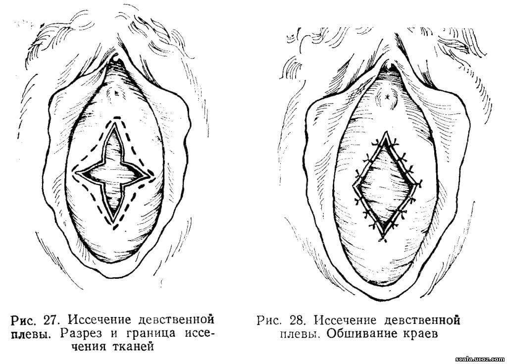 відновлення невинності