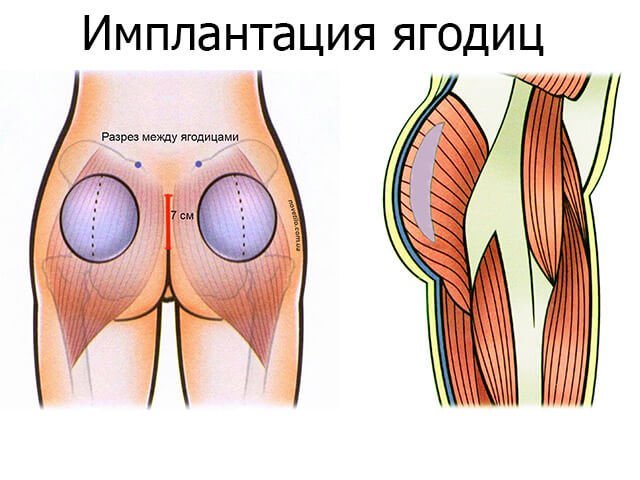 Операція імплантації сідниць