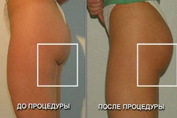 Хірургічна підтяжка сідниць
