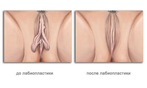 Результат зменшення великих статевих губ