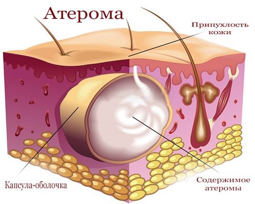 атерома