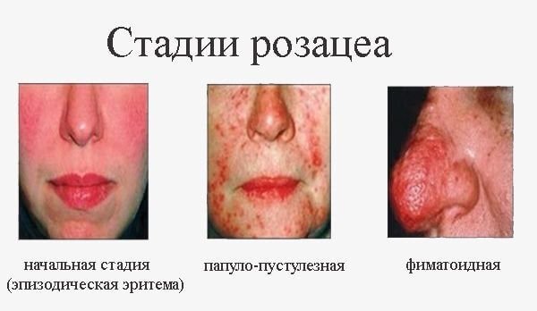 стадії розацеа