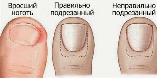 Профілактика врослого нігтя