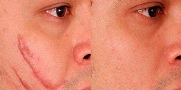 До і після видалення шраму