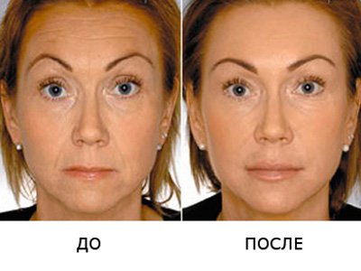 Контурна пластика обличчя гіалуронової кислотою