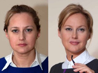 Як виглядають імпланти в вилиці