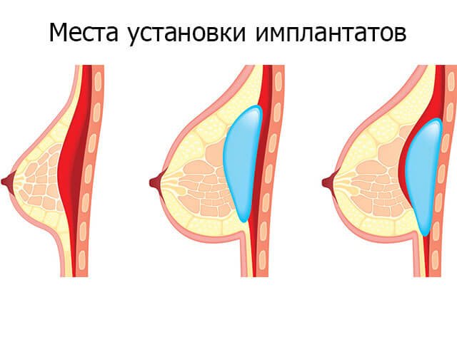 Місця установки імплантатів