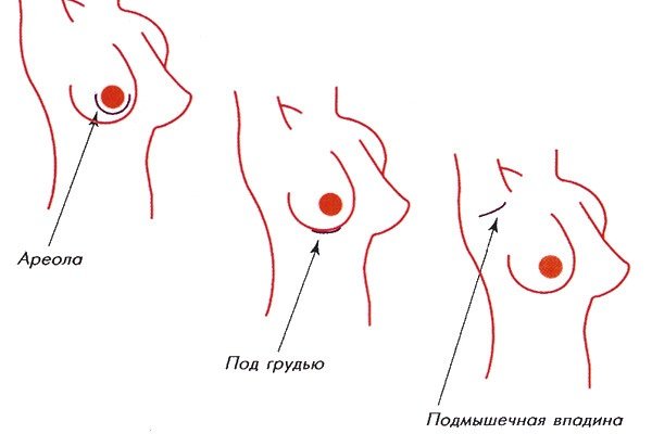 Способи операції по збільшенню грудних залоз