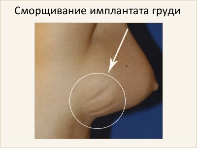 зморщування імплантанта