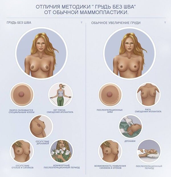 Процес виконання маммопластики через пахву