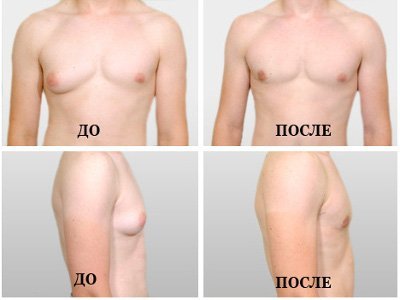чоловіча гінекомастія