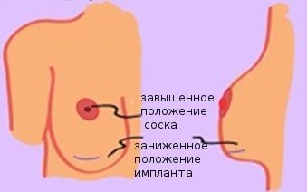 Як виглядають шрами після підтяжки грудей