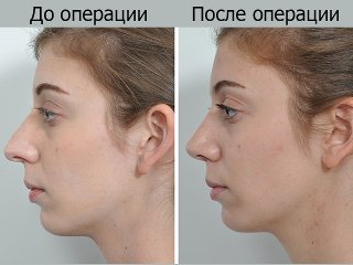 Отопластика вух