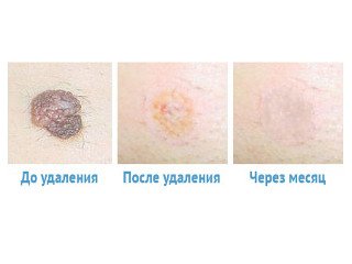 Видалення родимок на обличчі хірургічно