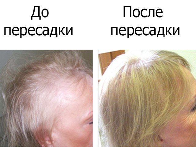 Пересадка штучного волосся Biofibre