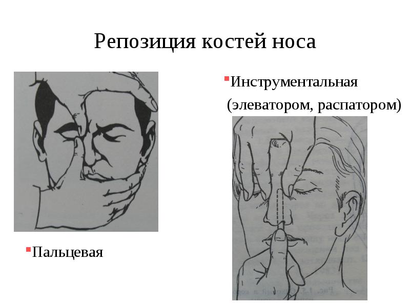 Репозиція кісток носа