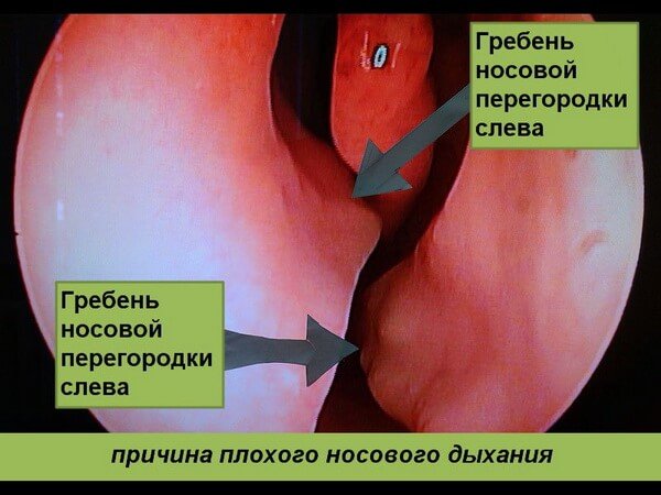 Наявність гребеня в носі - причина утрудненого носового дихання