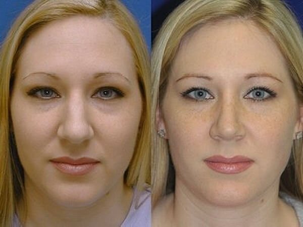 Ринопластика як варіант позбавлення від великого носа