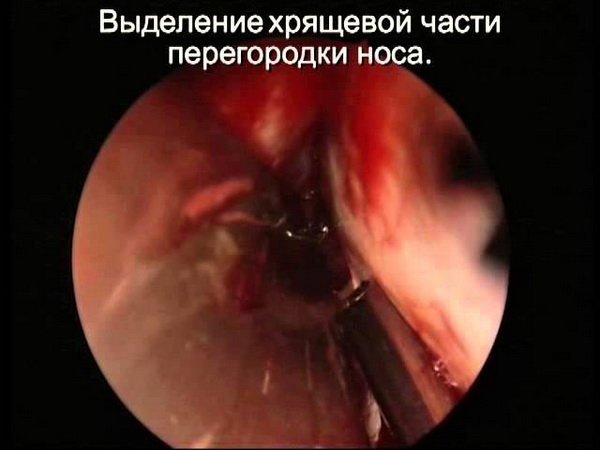 Виділення хрящової частини перегородки носа при септопластика