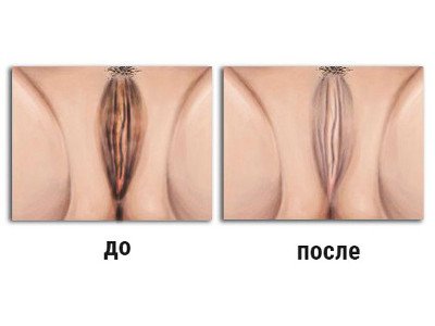 Процедура лазерної підтяжки піхви